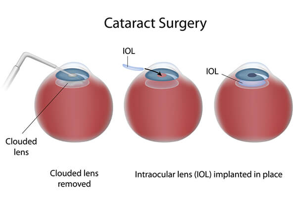 Cataract Surgery Coeur d'Alene