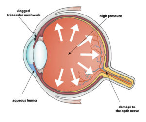 Glaucoma Coeur d'Alene