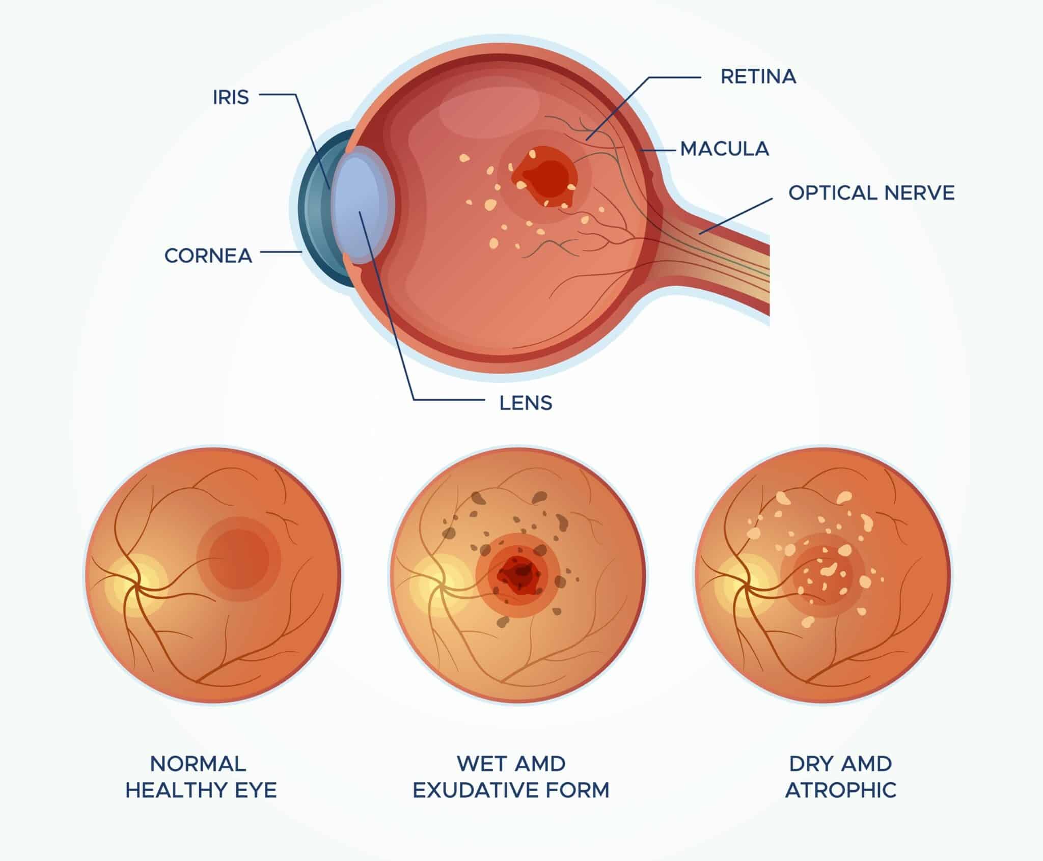 Diabetic Retinopathy Coeur d'Alene | Retinal Diseases Idaho